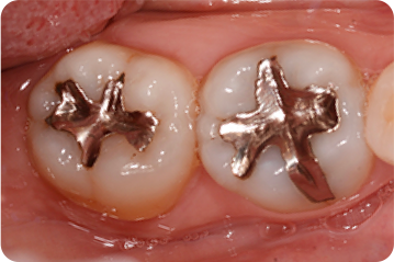 メタルインレー(銀の詰め物)：奥歯